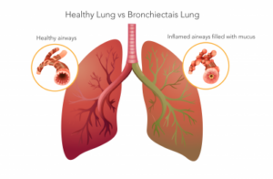 Importance of Patient Education in Bronchiectasis Treatment Adherence ...