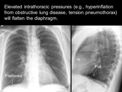 Disorders of the Diaphragm in COPD Patients - AffloVest